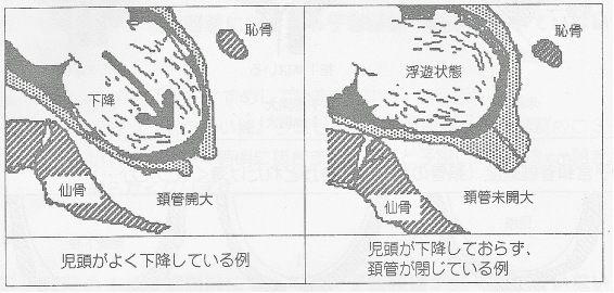 子宮口 3cm